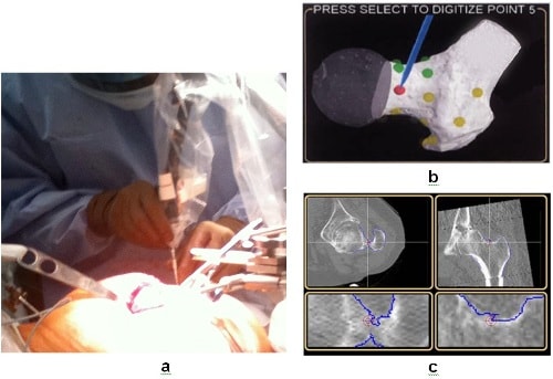 ROBODOC procedure (Image courtesy of Biomedhealhtech.com.)
