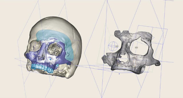 Figure 1.This skull was scanned, and the implant was designed in Autodesk Within Medical. (Image courtesy of Autodesk.)