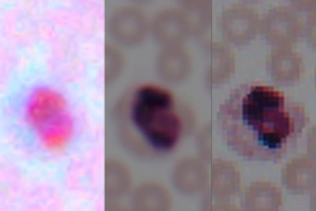 A blood smear taken by a smartphone camera (left), following enhancement by the UCLA team’s technique (center), and taken by a lab microscope (right). (Image courtesy of Ozcan Research Group/UCLA.)