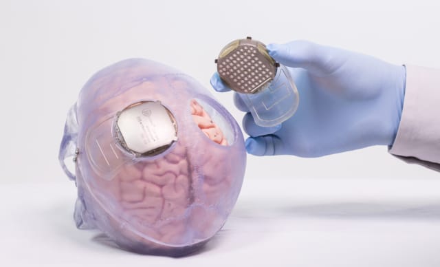 The WIMAGINE implant has electronic boards that wirelessly transmit the data from brain signals that are triggered when a person moves, allowing for control of an exoskeleton. (Image courtesy of Clinatec.)