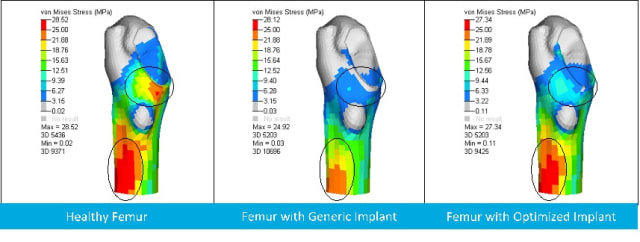 Figure 3. von Mises plots showing stress shielding of a human femur. (Image courtesy of Altair.)