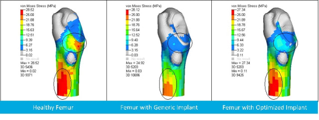 Figure 3. von Mises plots showing stress shielding of a human femur. (Image courtesy of Altair.)