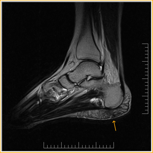 Inflamed heel fat pad syndrome or inflammation. (Picture courtesy of Sumer's Radiology Blog.)