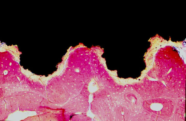 Figure 6. Osseointegration at work. The black is the titanium implant, while the pink stuff is bone. (Image courtesy of Wikipedia.)