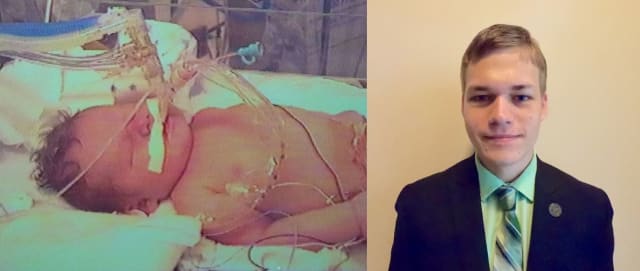 Levi Zima as a neonatal pneumonia patient (left) and a 21-year-old engineering student (right). (Images courtesy of Levi Zima.)