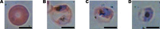 four cells as seen under a microscope in different stages of infection from a malarial parasite. The first image is uninfected, but as the parasite matures in the images from left to right, the cell deforms. (Image courtesy of Adam Wax/Duke University.)