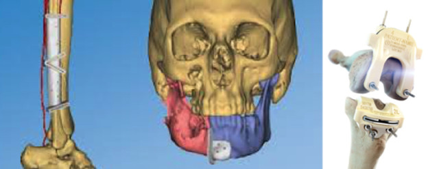 A model of patient-specific CMF surgical guides and knee resection guides. (Image courtesy of DePuy Synthes.)