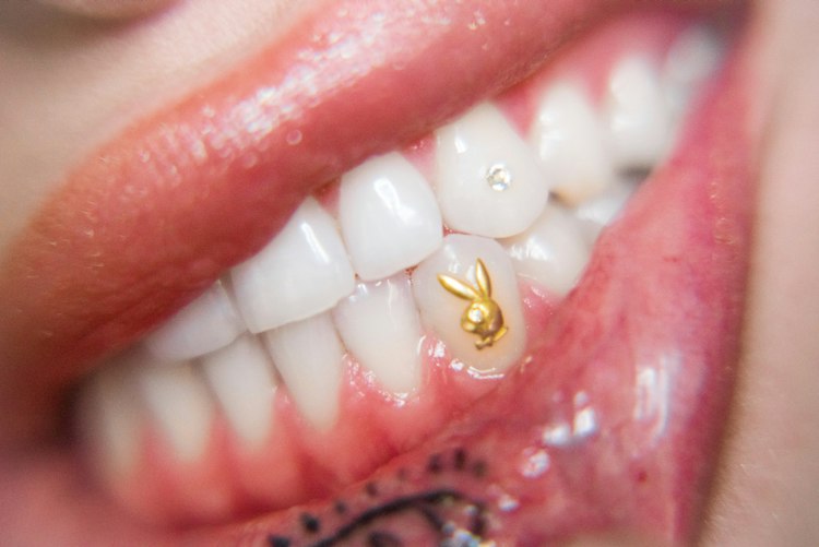 Tooth Gems