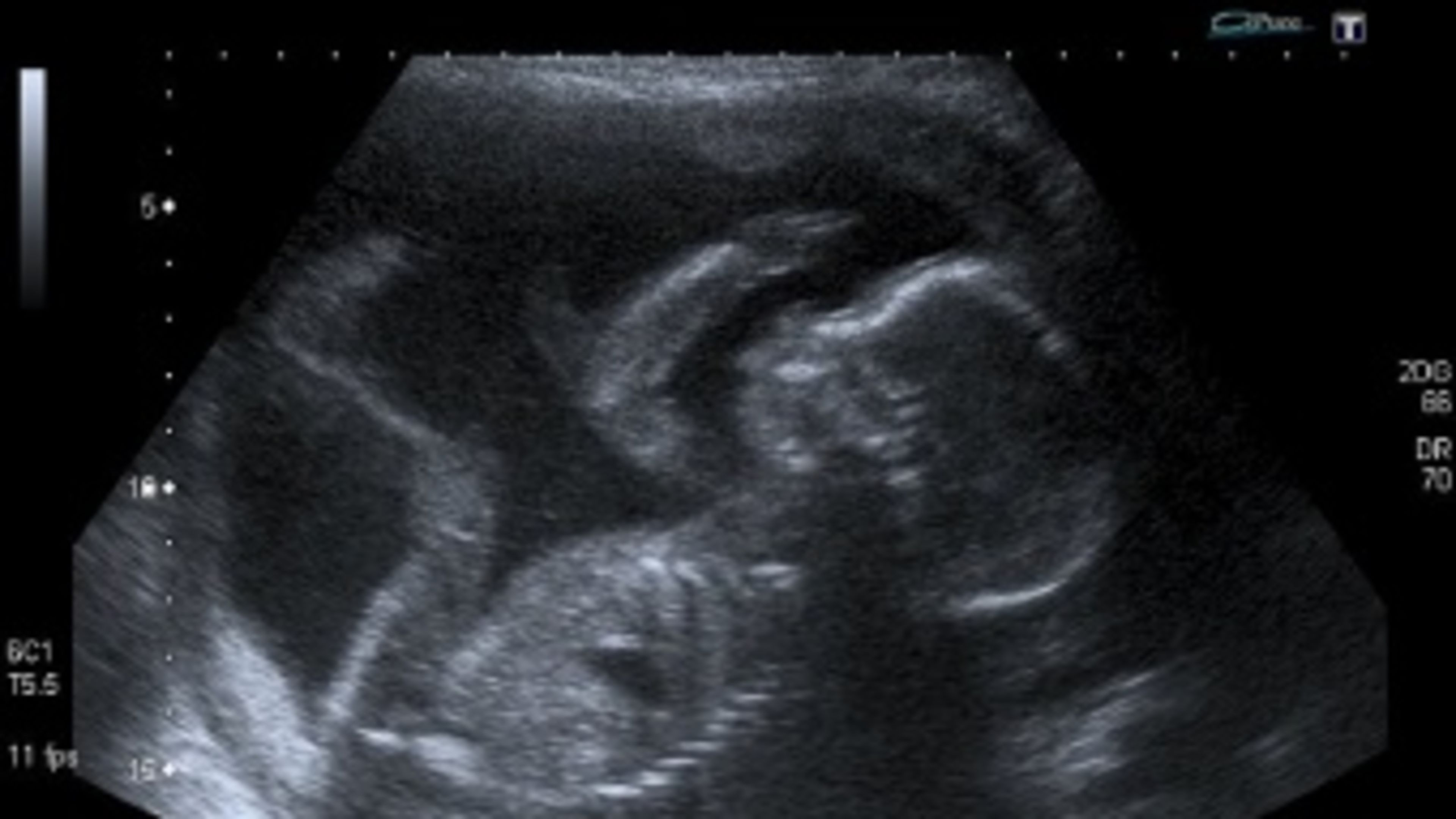 Supreme Court temporarily lifts ban on mail-order abortion drugs