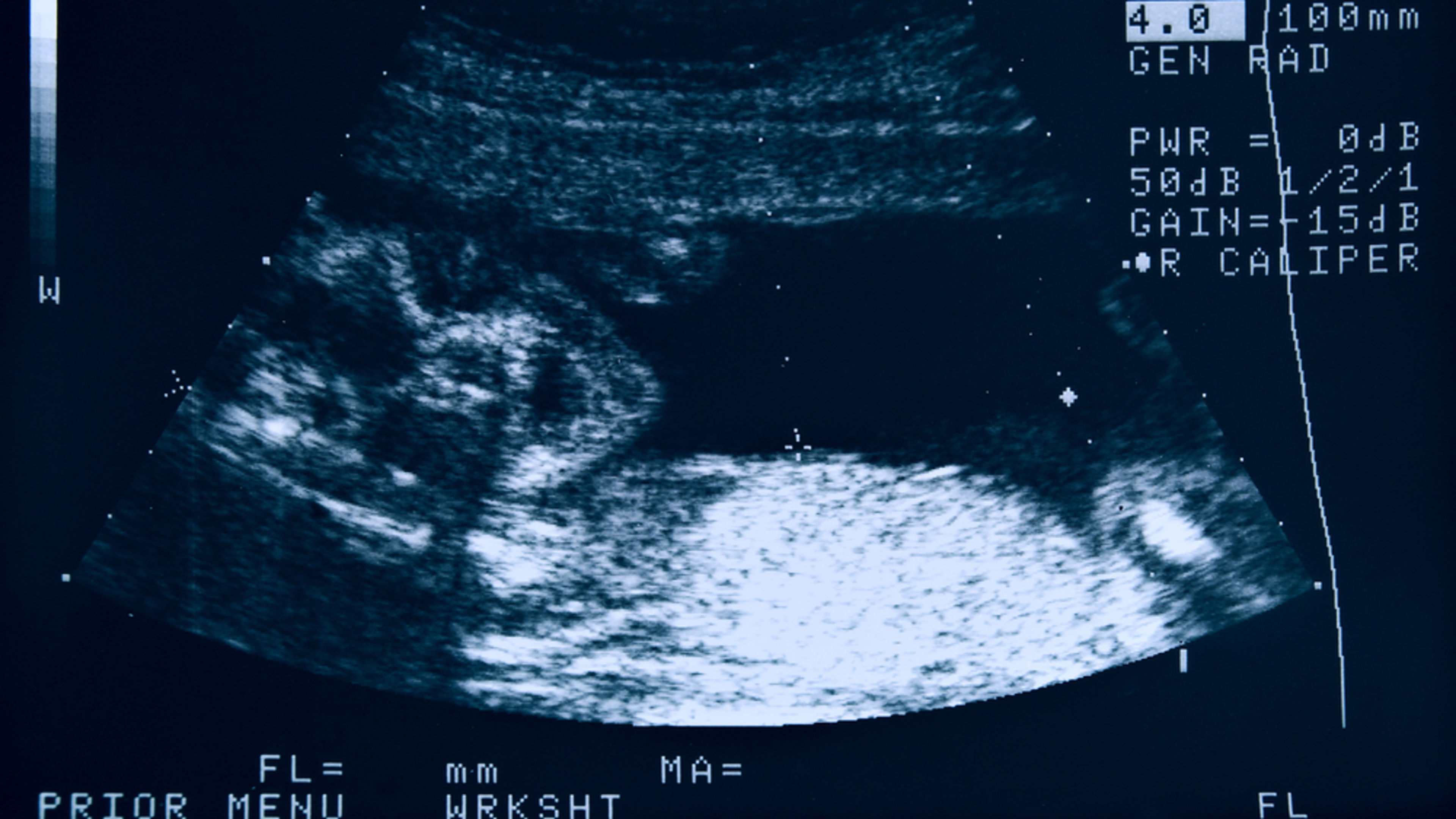 Lawmakers, activists rally behind proposed ban of ‘inhumane’ dismemberment abortion
