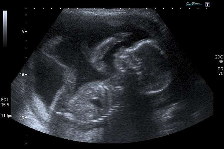 An unborn baby at 20 weeks. | Credit: Steve via Flickr (CC BY-NC 2.0)