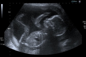 Supreme Court temporarily lifts ban on mail-order abortion drugs