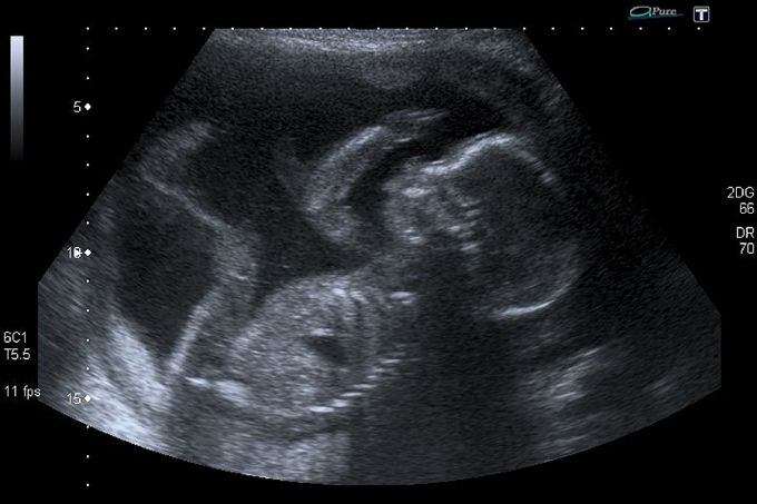 Poll: Only 37% of Americans identify as pro-life, but 67% want limits on abortion