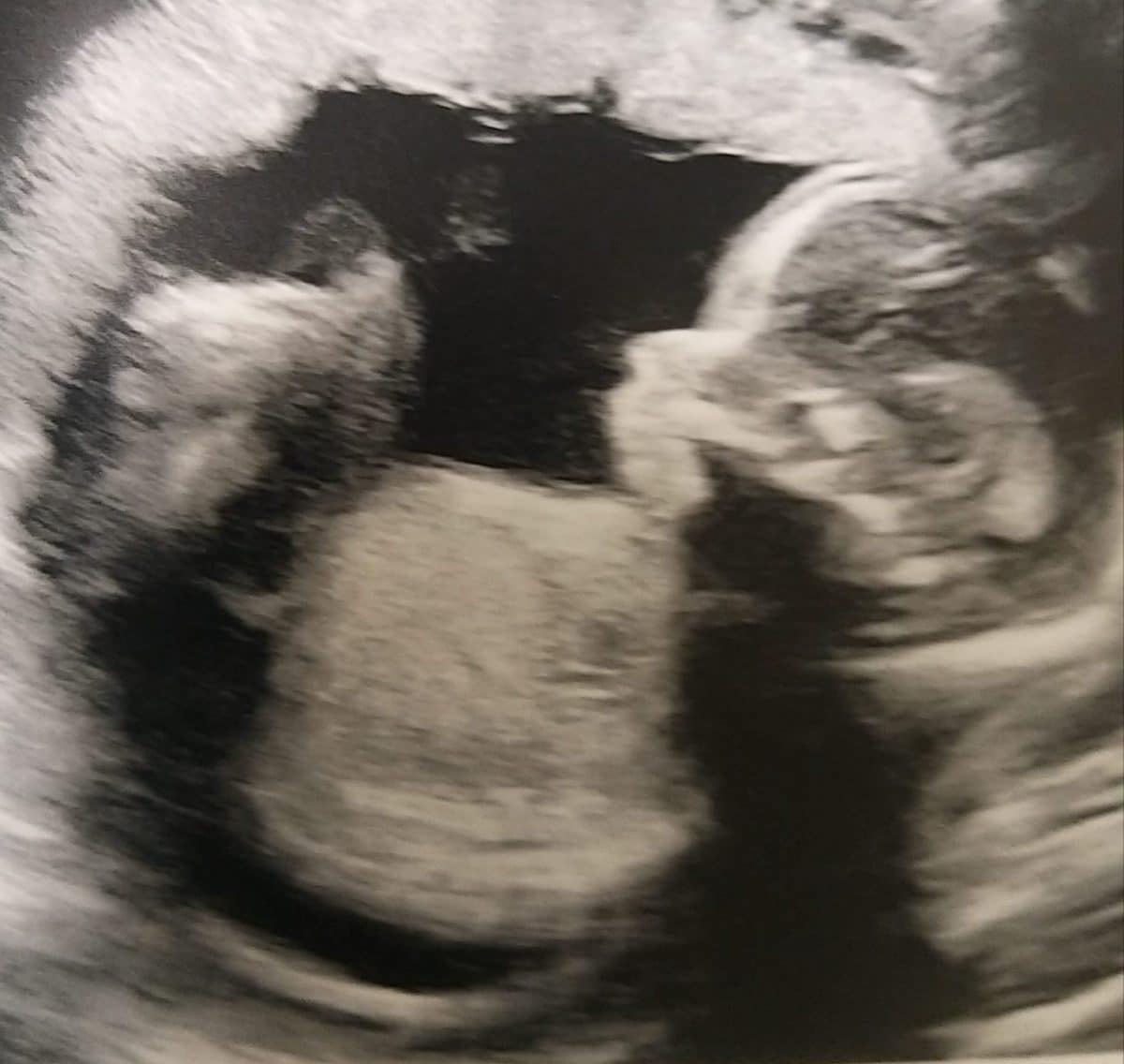 Rainbow baby 20 week scan