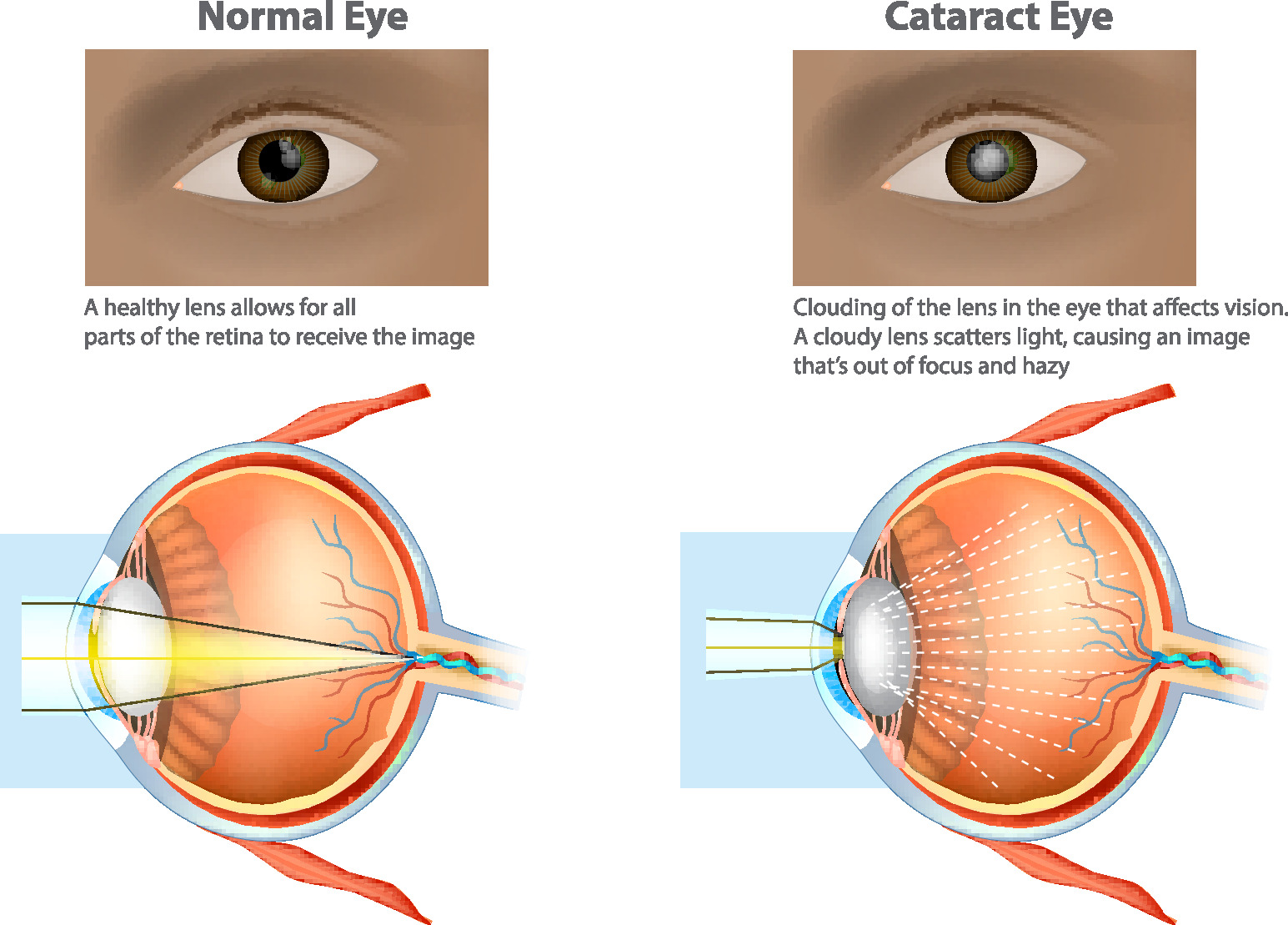 normal vs cataract eye