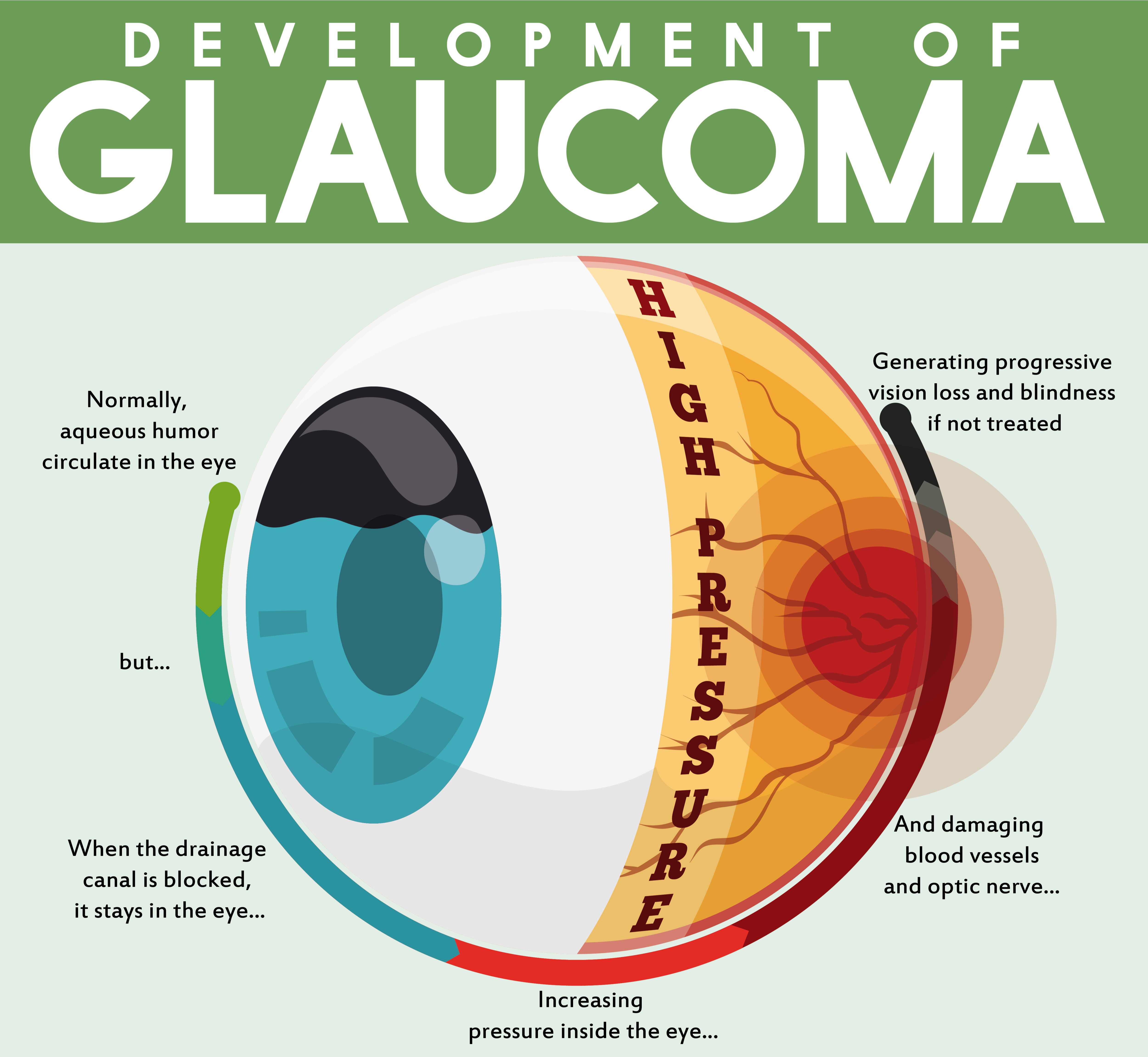 Vision loss. Заболевание глаз глаукома. Здоровый глаз и глаукома.