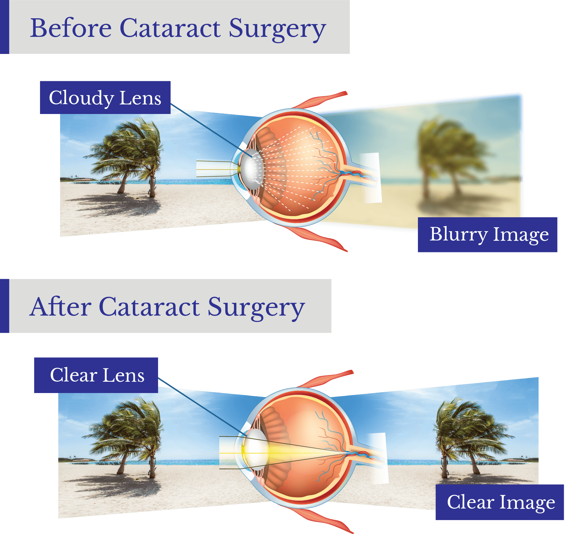 Cataract Consultation Checklist