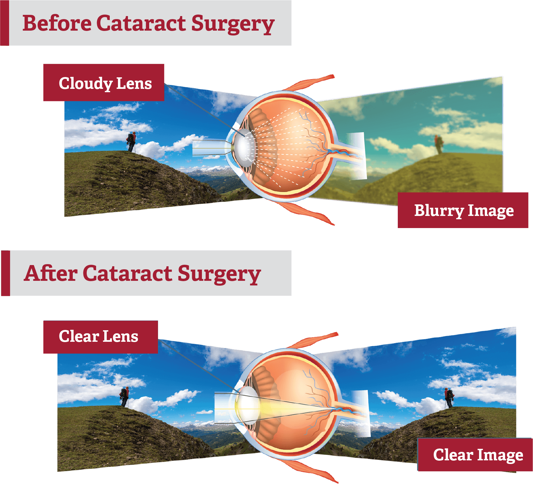 before and after cataract surgery