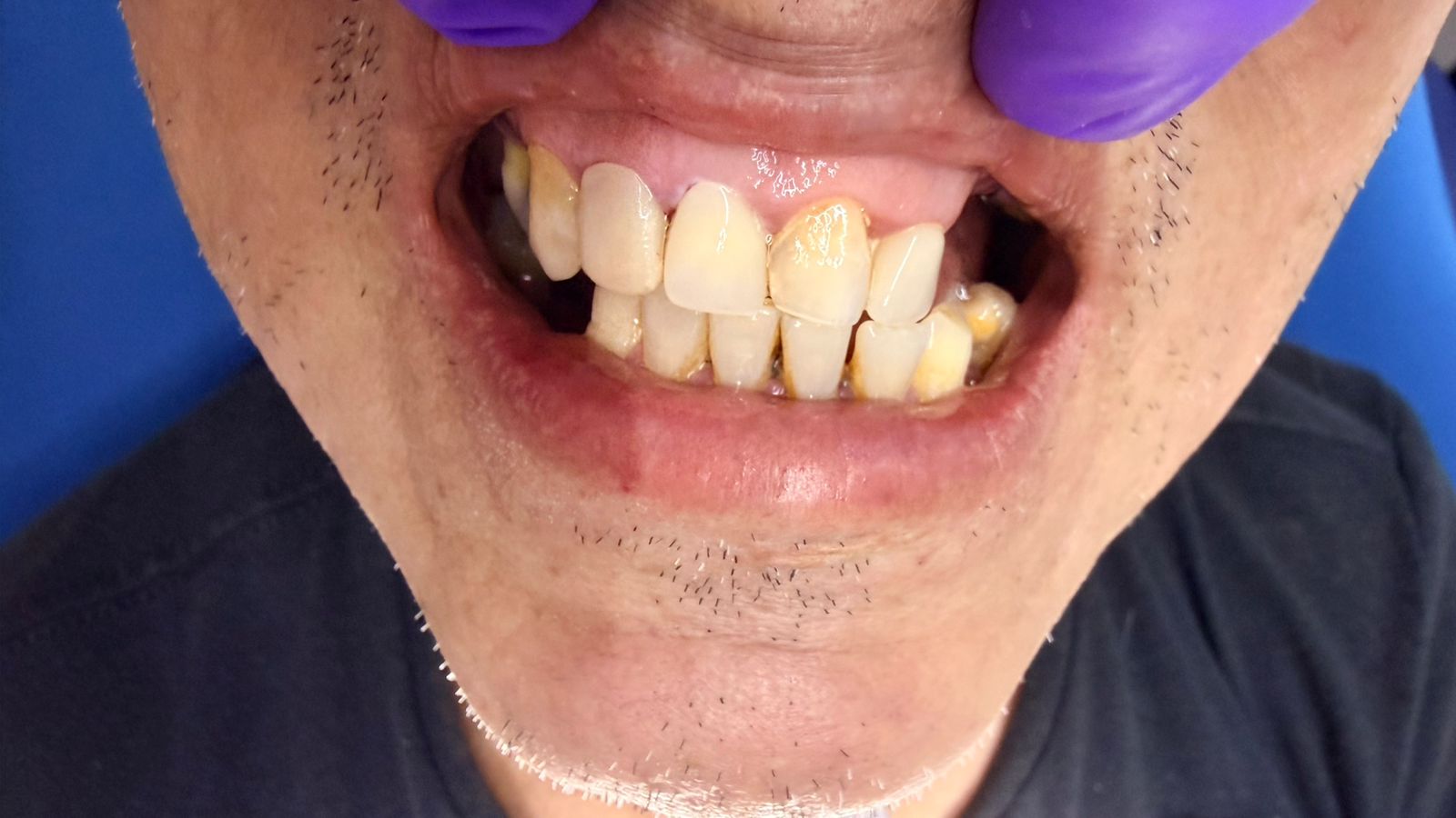 Before treatment