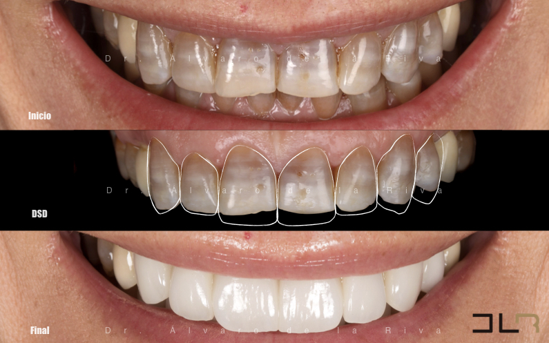 Digital Smile Design — Dental Avenue