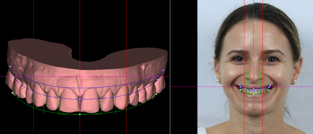 Smile Design result
