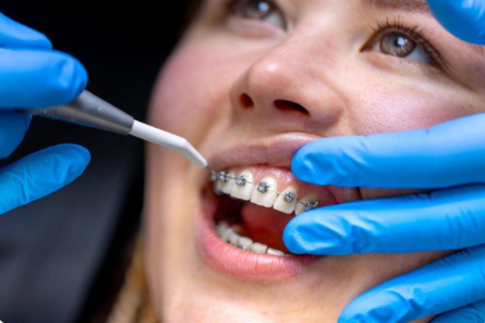 Adult orthodontics treatment