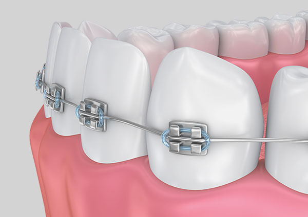 Orthodontics treatment