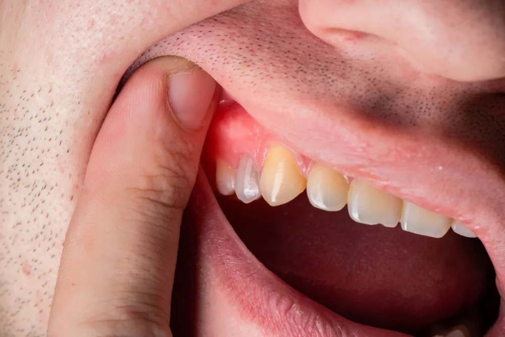 Everything about root canal treatment