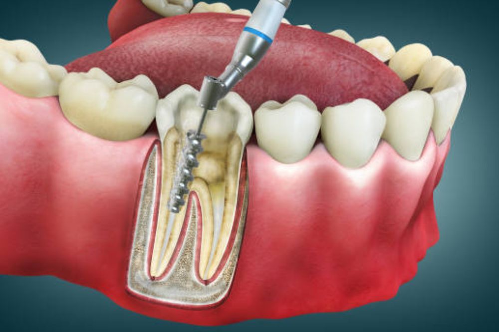 Root canal treatment types