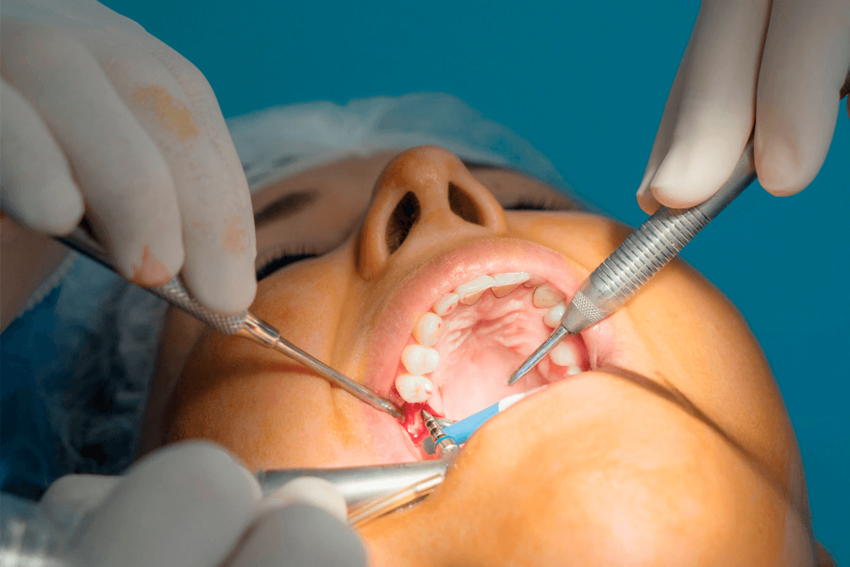 When to get a root canal