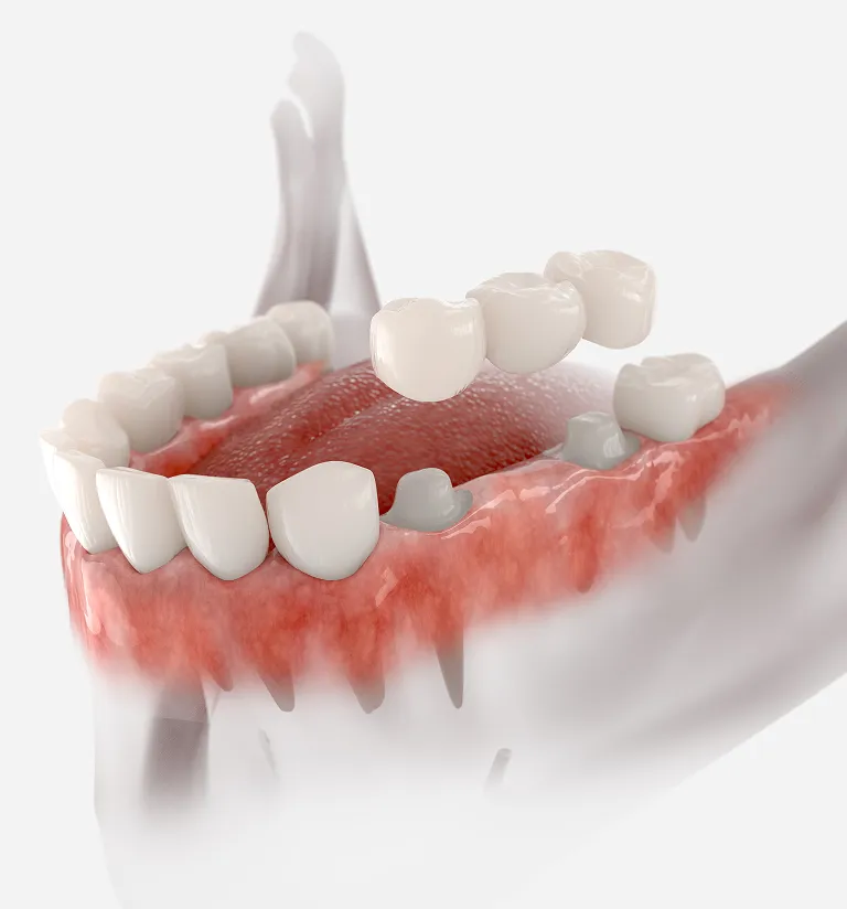 Dental crown result