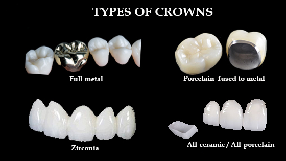 Types of crown materials