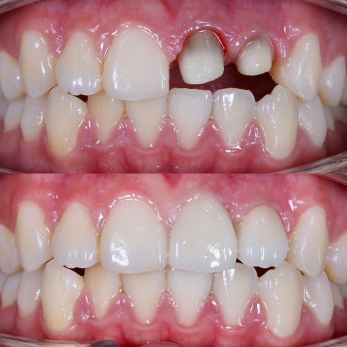 Understanding dental crowns
