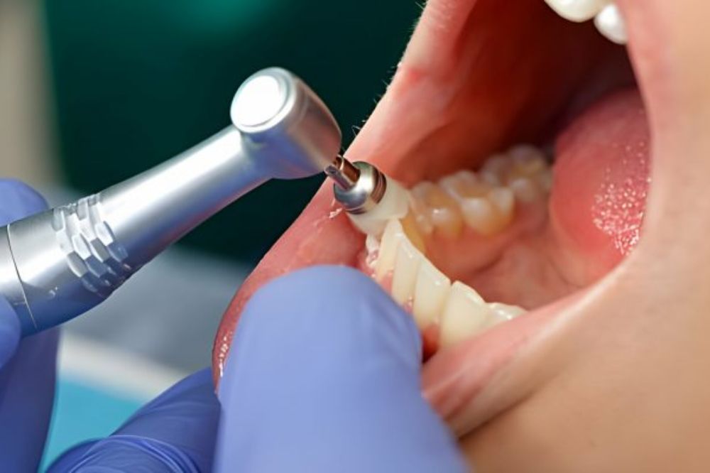 Step by step dental cleaning guide