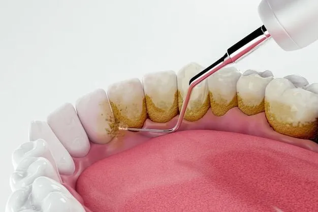 Dental cleaning plaque removal illustration