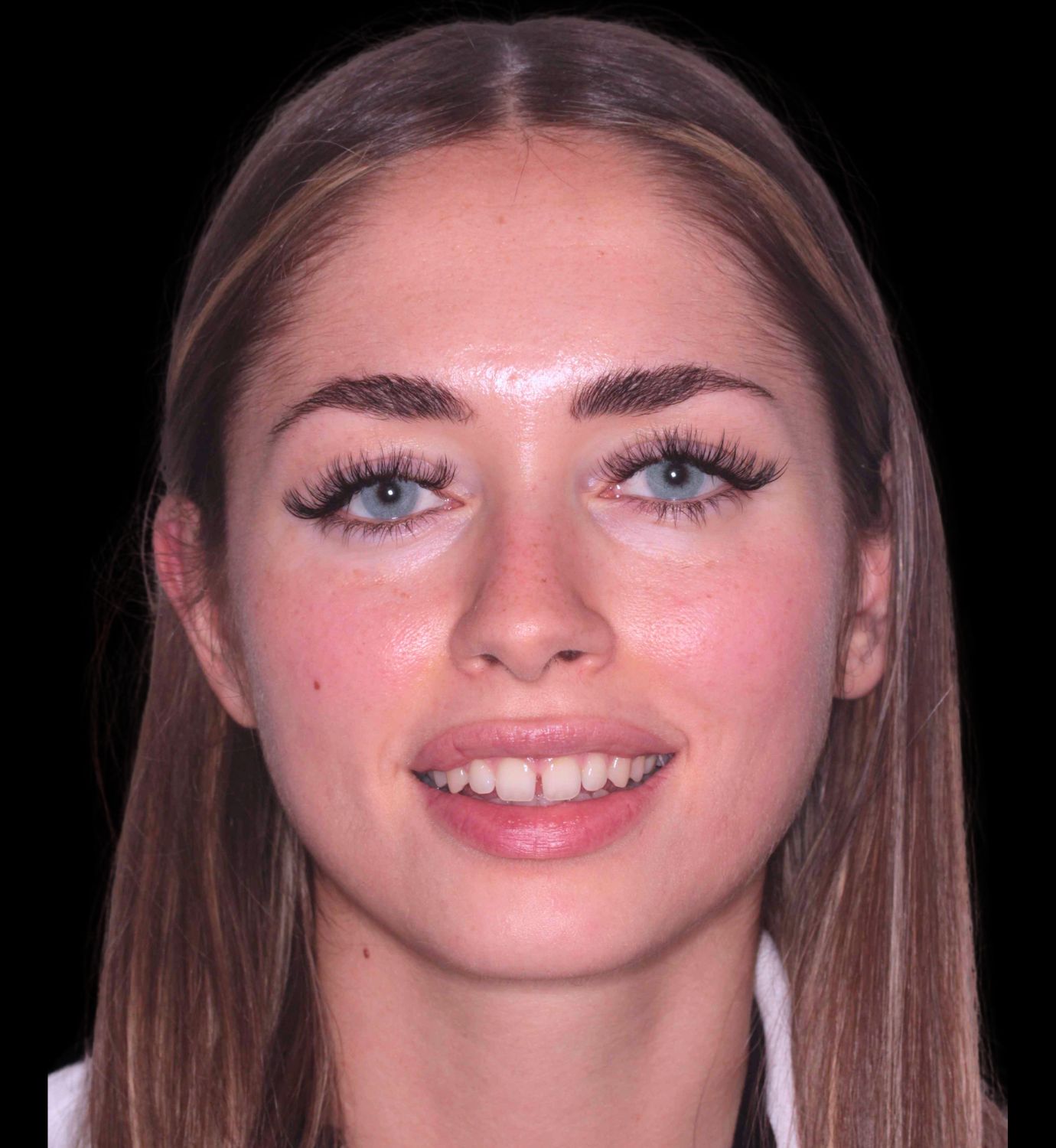 fotografía de antes de ortodoncia con Invisalign