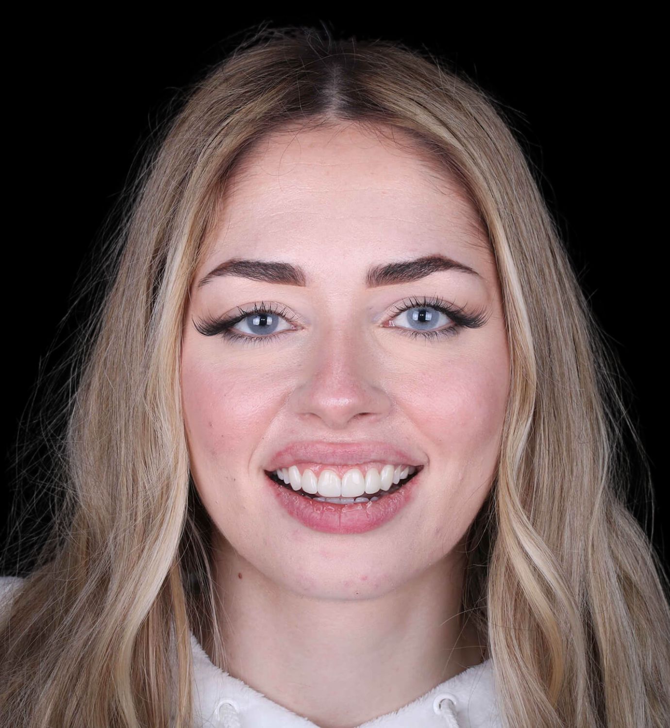 fotografía de después de ortodoncia con Invisalign