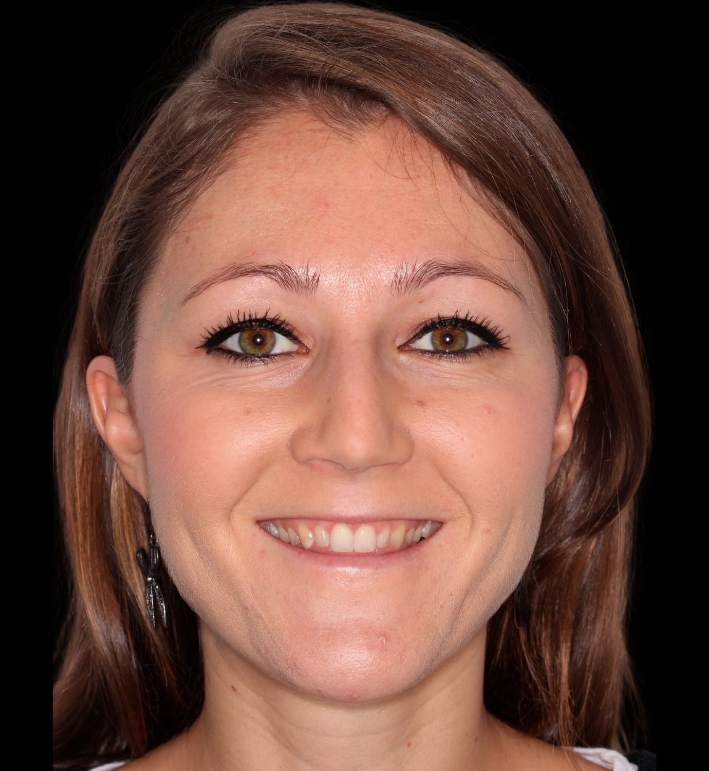 Fotografía de antes de caso con implantes