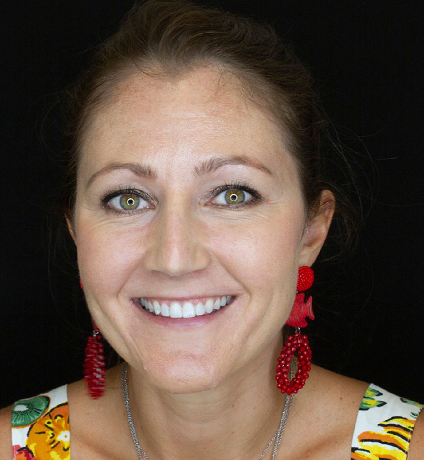 Fotografía de después de caso con implantes