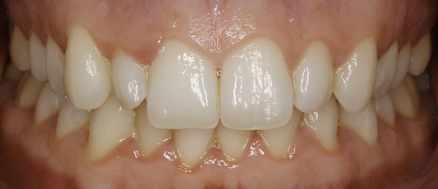 Antes de Invisalign