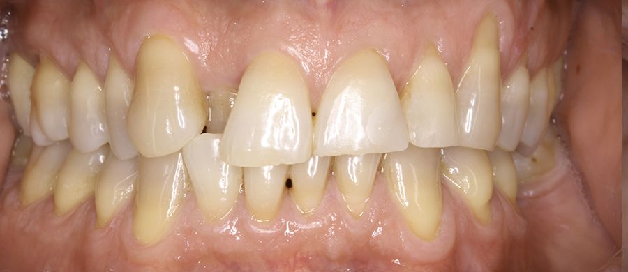 Antes de Invisalign
