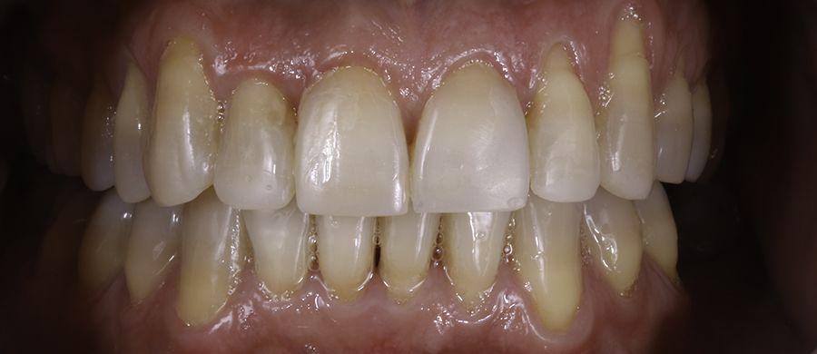 Después de Invisalign