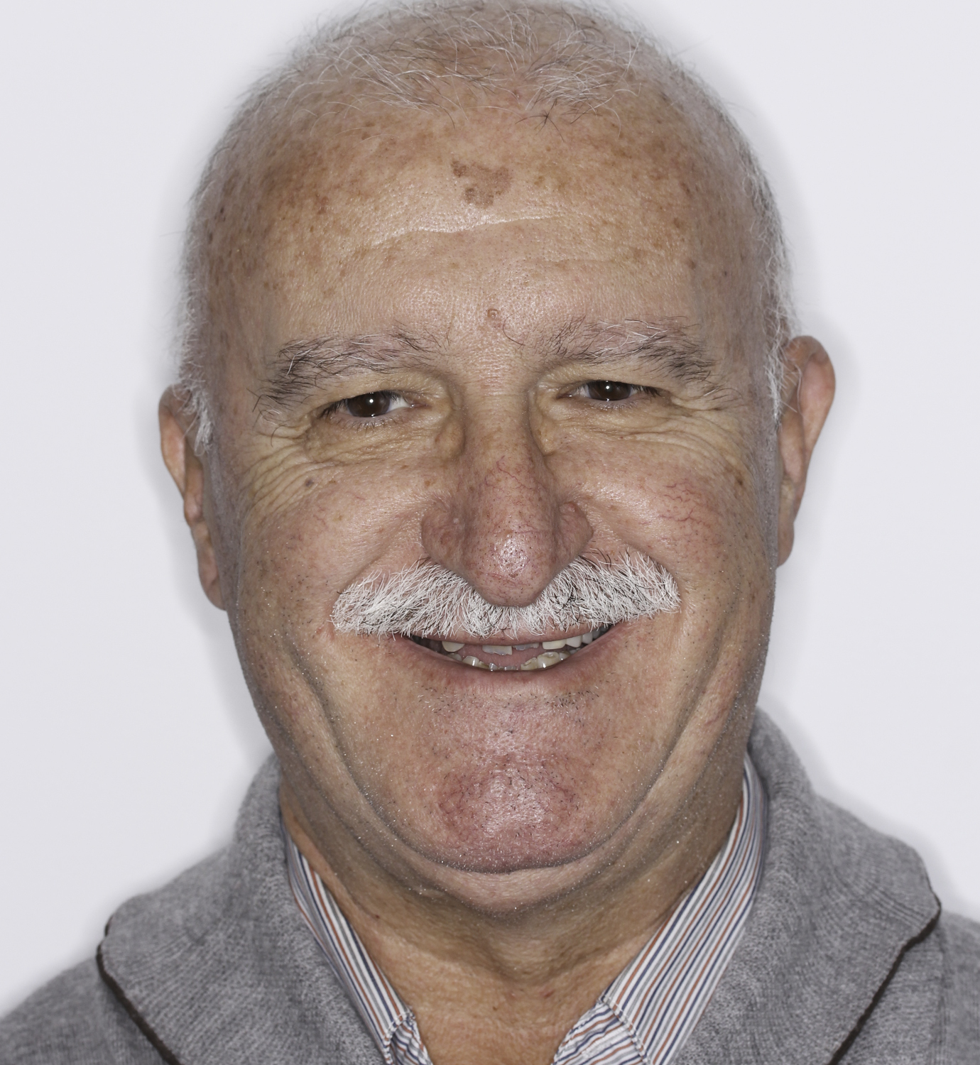 fotografía de antes de ortodoncia con Invisalign