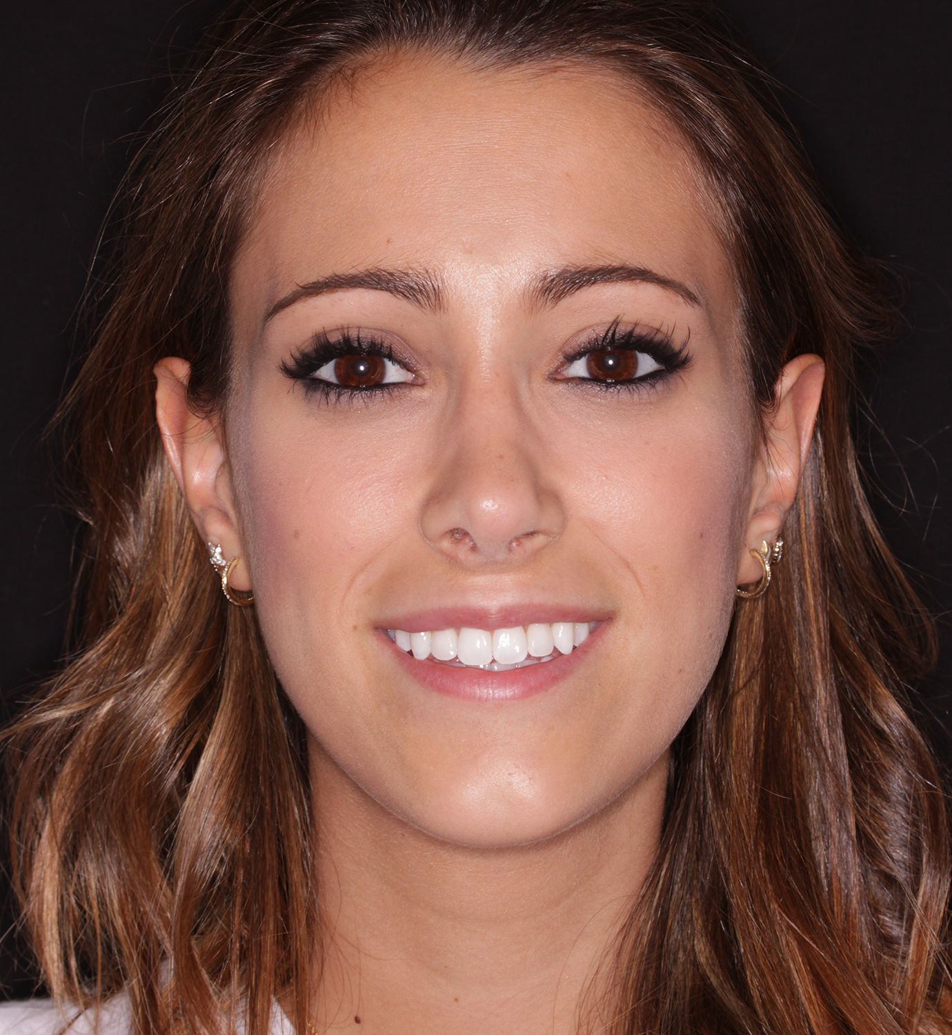 fotografía de después de ortodoncia con Invisalign