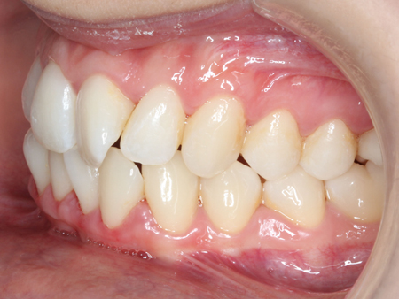 Antes
