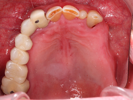 Antes