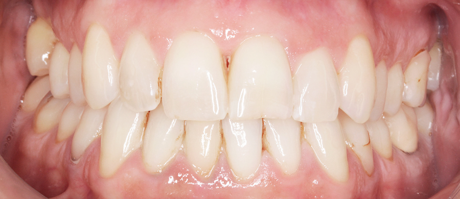 Después de Invisalign