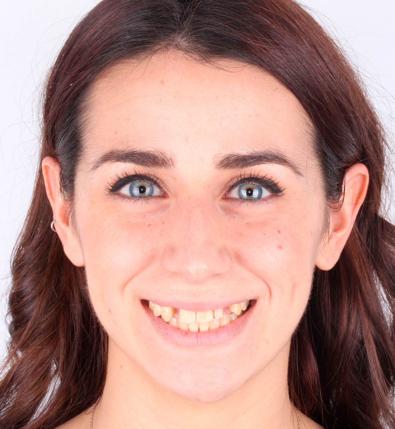 fotografía de antes de implantes dentales