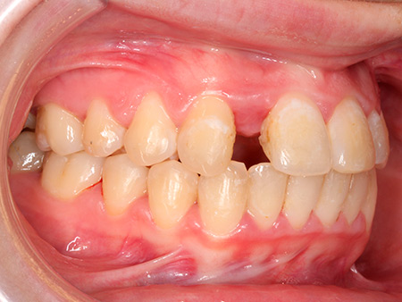 Antes