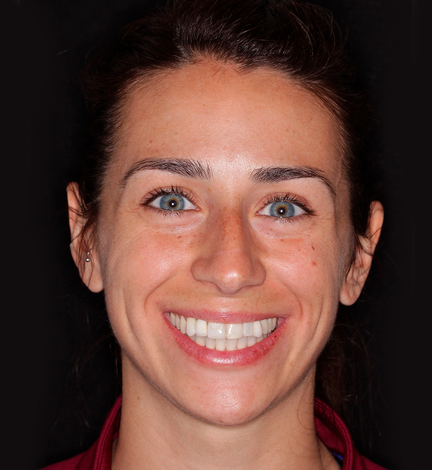 fotografía de después de implantes dentales